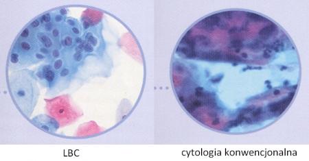LBC i cytologia konwencjonalna