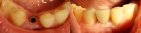Uzupełnienie pojedynczego zęba w oparciu o implant.