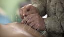 Akupunktura - alternatywa dla tradycyjnego leczenia