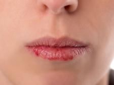 Suchość w ustach: przyczyny i zapobieganie