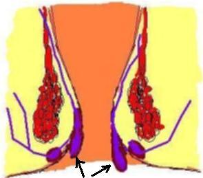 wypadające hemoroidy - schemat