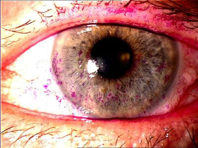 Zmniejszone wytwarzanie łez powoduje, że rogówka wysycha, oczy są zaczerwienione i pieką