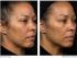 Efekt działania zabiegu Thermage na twarz po 4 miesiącach (1)