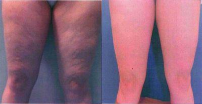 Zdjęcia obrazują stan skóry przed (zdjęcie z lewej) i po (zdjęcie z prawej) zabiegach na Celluwell S