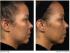 Efekt działania zabiegu Thermage na twarz po 4 miesiącach (2)