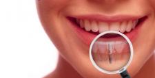 Implanty stomatologiczne – czym kierować się przy ich wyborze?