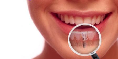 Implant stomatologiczny to tytanowa śruba, która imituje korzeń zęba.