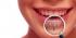 Implant stomatologiczny to tytanowa śruba, która imituje korzeń zęba.