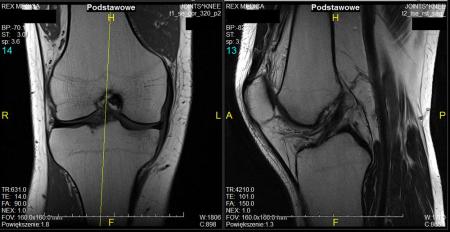 obraz z rezonansu kolana
