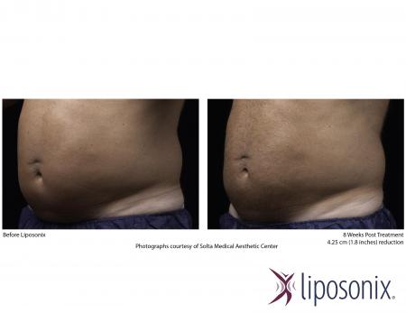 Przed i po u meżczyzny - efekty zabiegu Liposonix