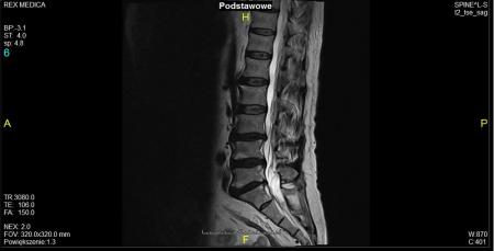 dyskopetia na zdjęciu rezonansu
