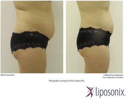 Przed i po - efekty zabiegu Liposonix