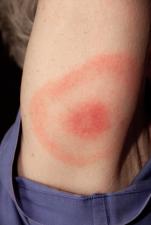Borelioza - choroba z Lyme