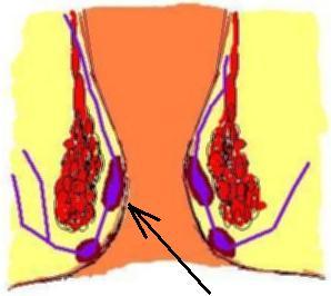 hemoroidy - schemat