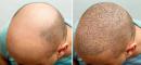 ‍Wszystko, co powinieneś wiedzieć o przeszczepie włosów metodą FUE: Wskazania, procedura i efekty