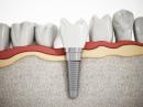Implanty stomatologiczne – piękny uśmiech na długie lata
