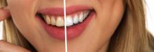Zapytaj stomatologa –  Białe zęby i piękny uśmiech