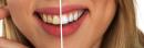 Jakie zabiegi są zalecane przed wybielaniem zębów?