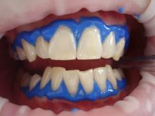Jak wygląda wybielanie zębów w profesjonalnym gabinecie stomatologicznym?