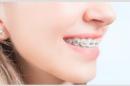 Higiena jamy ustnej przy aparacie ortodontycznym