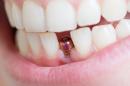 Co warto wiedzieć o implantach zębów?